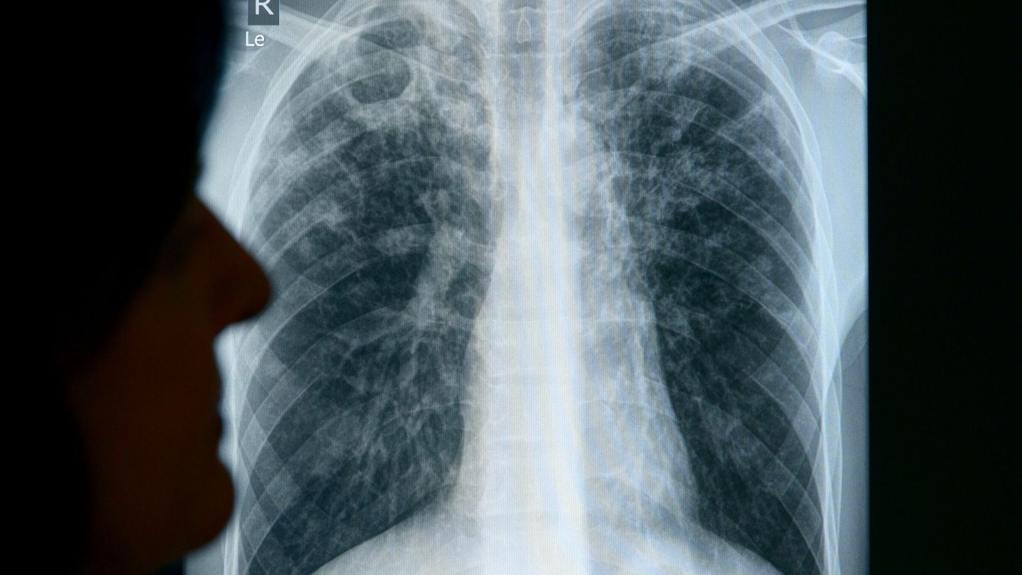 Infektionsgeschehen: Anstieg von gemeldeten Tuberkulosefällen in Sachsen